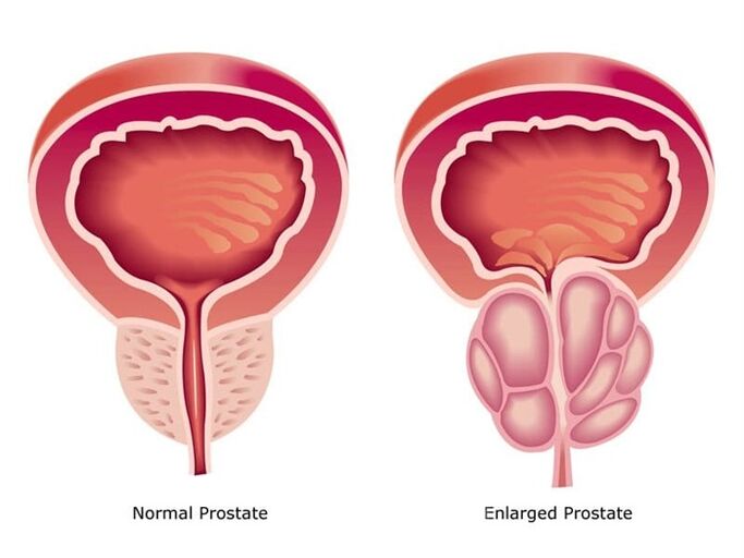 Prostovit normalizuje prácu a veľkosť prostaty