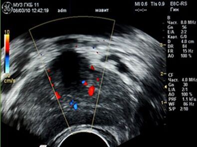 Ultrazvuk ukázal ložiská zápalu v prostate