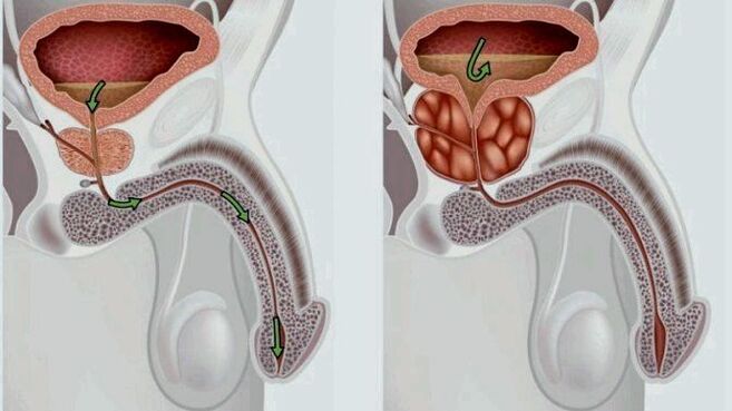 zdravá a zapálená prostata s prostatitídou