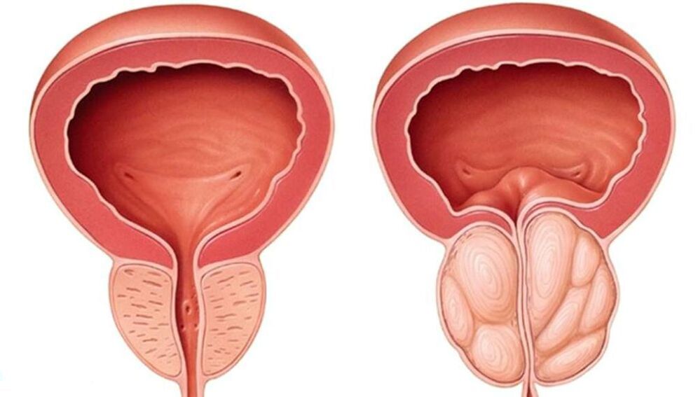 normálna a zväčšená prostata